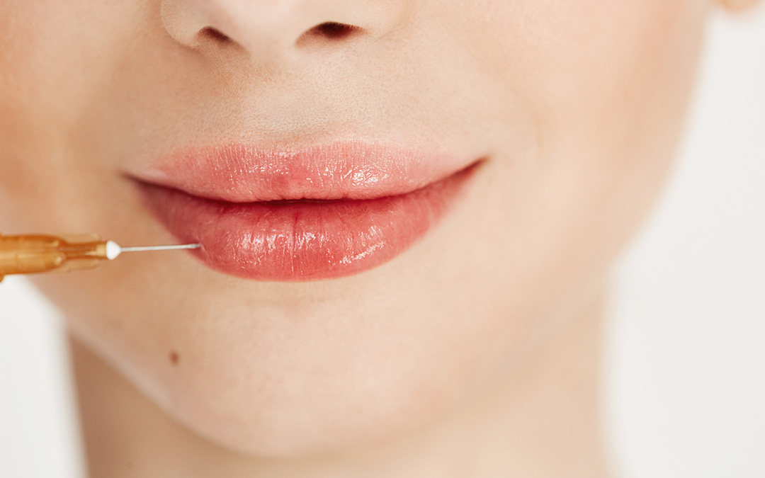 Labios voluminosos con ácido hialurónico