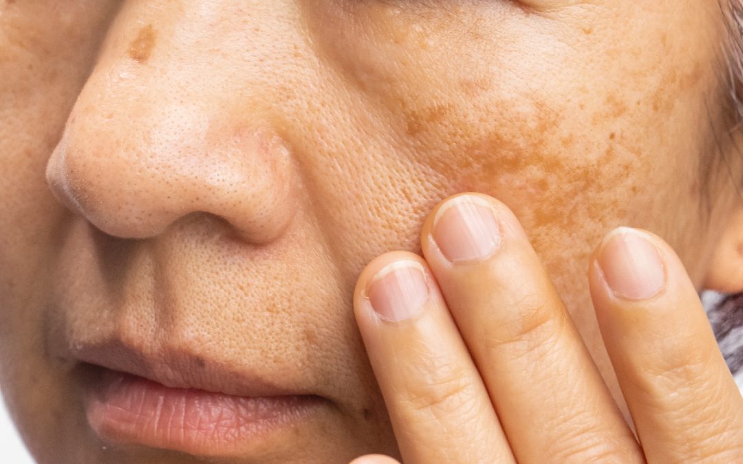 Melasma: qué es y cómo prevenir y tratar