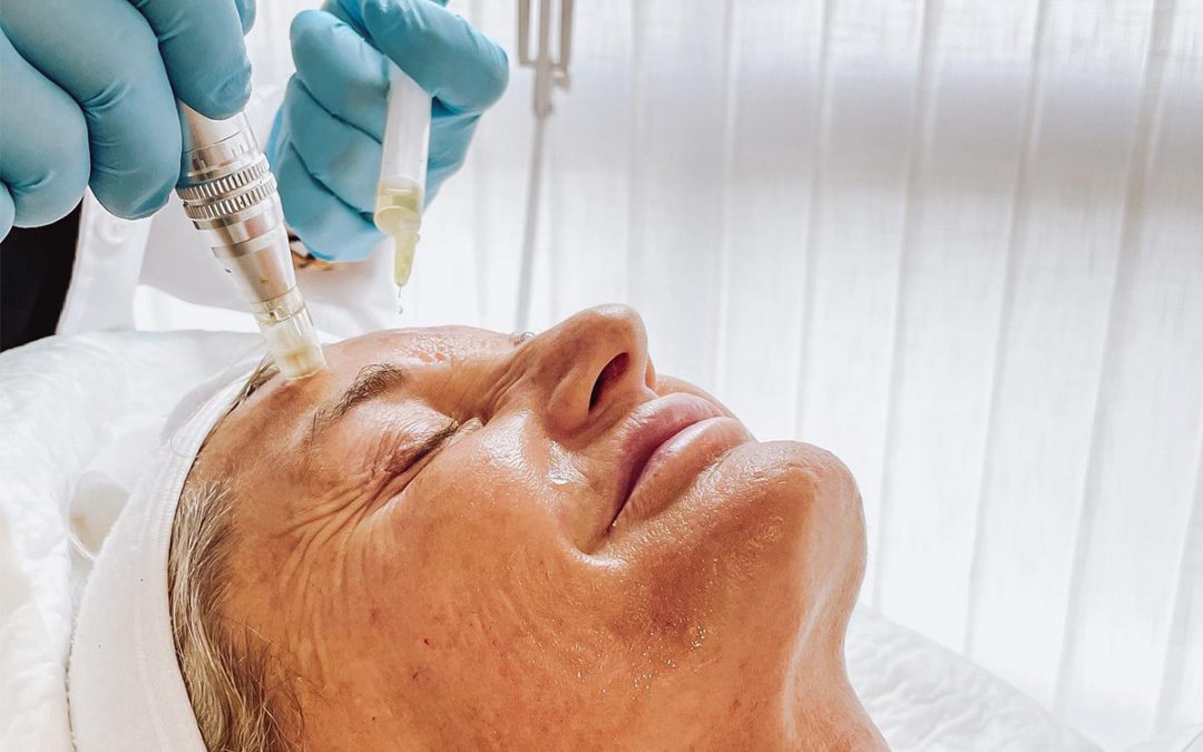 Rejuvenecimiento facial con Dermapen